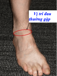 Minh họa vị trí đau trong hẹp khoang trước khớp cổ chân