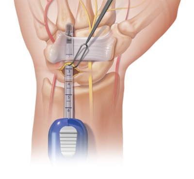 Điều trị hội chứng ống cổ tay với kỹ thuật nội soi một lỗ