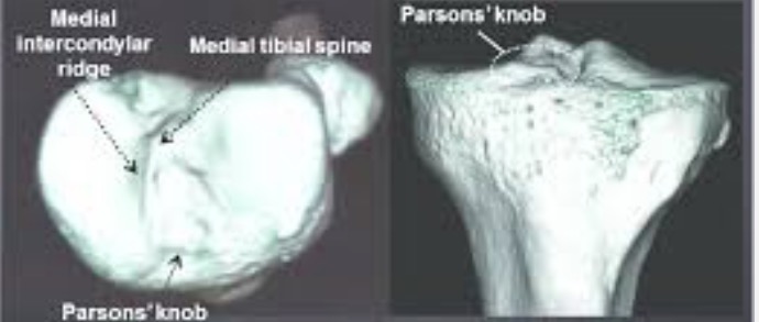 GÒ PARSONS (PARSONS' KNOB): MỘT MỐC GIẢI PHẪU CỦA ĐIỂM BÁM DÂY CHẰNG CHÉO TRƯỚC KHỚP GỐI