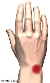 Hoại tử vô khuẩn xương nguyệt cổ tay(Kienbock disease): một nguyên nhân của đau khớp cổ tay 