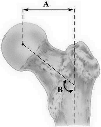 Kiểm soát OFFSET của cổ xương đùi trong thay khớp háng: một yếu tố quan trọng đảm bảo hiệu quả phẫu thuật