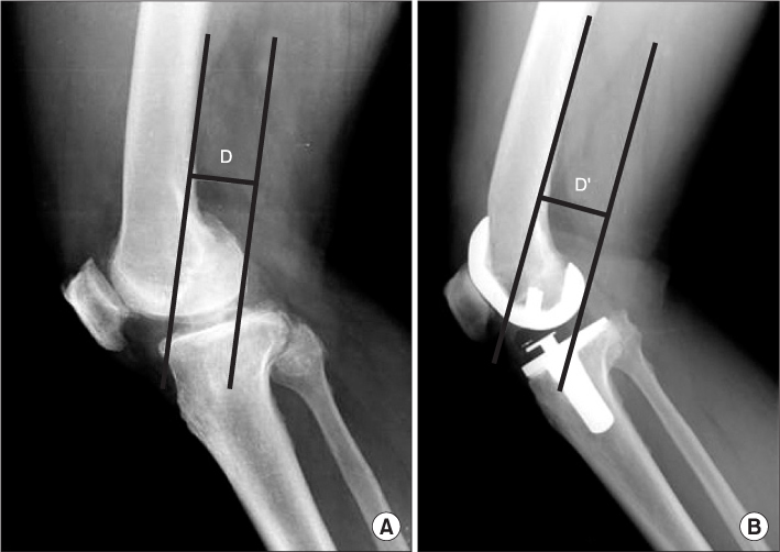 OFFSET PHÍA SAU CỦA LỒI CẦU XƯƠNG ĐÙI