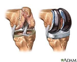 Phẫu thuật thay khớp gối: kỹ thuật có thực sự đơn giản ?