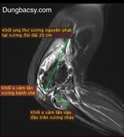 Các hình thái tổn thương ung thư xương nhiều vị trí