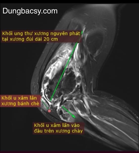 Các hình thái tổn thương ung thư xương nhiều vị trí