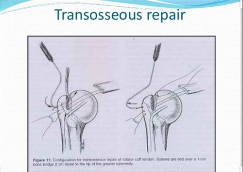 Kỹ thuật khâu xuyên xương trong khâu gân chóp xoay khớp vai