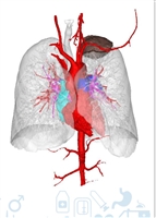 Ung thư xương di căn phổi có phải là “dấu chấm hết”