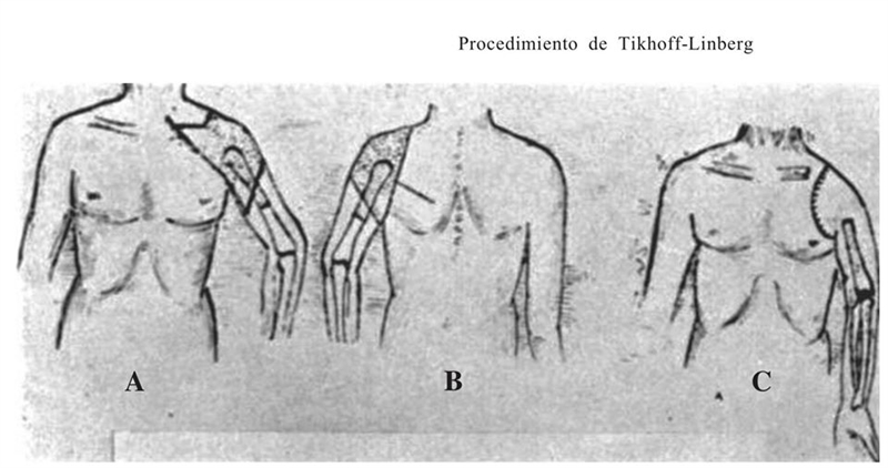 Tikhoff Linberg Incision PHẪU THUẬT TIKHOFF-LINBERG: “đêm trước” của phẫu thuật thay xương bả ...